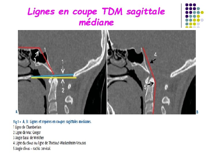 Lignes en coupe TDM sagittale médiane 