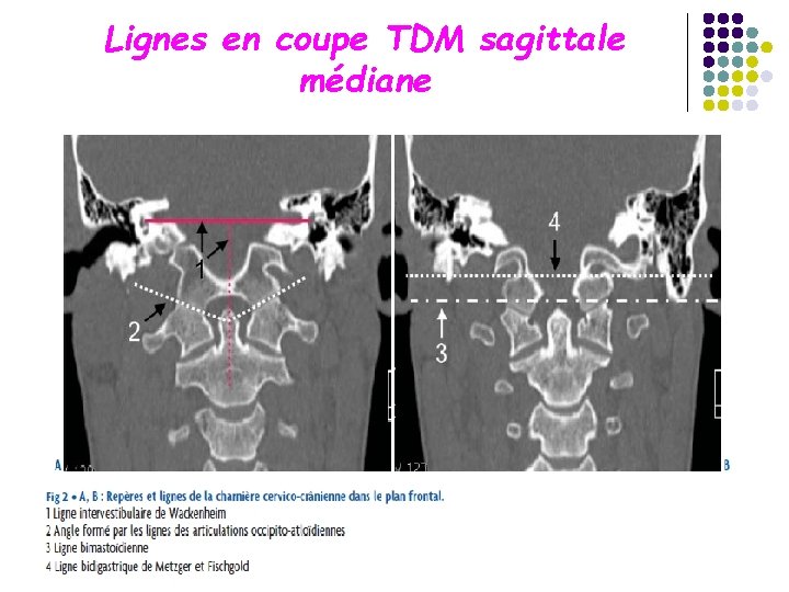 Lignes en coupe TDM sagittale médiane 