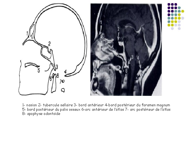 1 - nasion 2 - tubercule sellaire 3 - bord antérieur 4 -bord postérieur