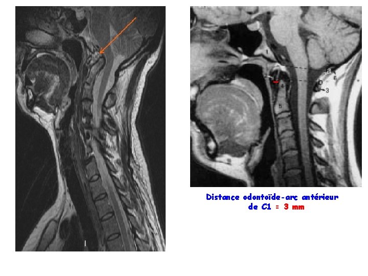 Distance odontoïde-arc antérieur de C 1 = 3 mm 