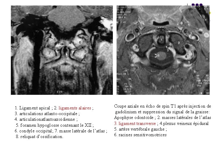 1. Ligament apical ; 2. ligaments alaires ; 3. articulations atlanto-occipitale ; 4. articulationatlantoaxoïdienne