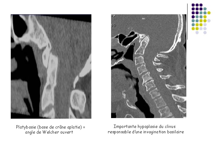 Platybasie (base de crâne aplatie) = angle de Welcher ouvert Importante hypoplasie du clivus