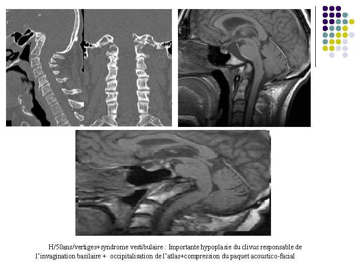 H/50 ans/vertiges+syndrome vestibulaire : Importante hypoplasie du clivus responsable de l’invagination basilaire + occipitalisation