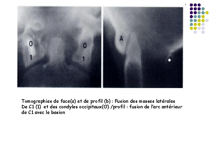 Tomographies de face(a) et de profil (b) : Fusion des masses latérales De C