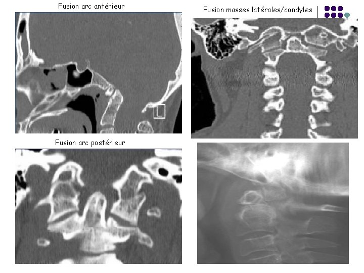Fusion arc antérieur Fusion arc postérieur Fusion masses latérales/condyles 