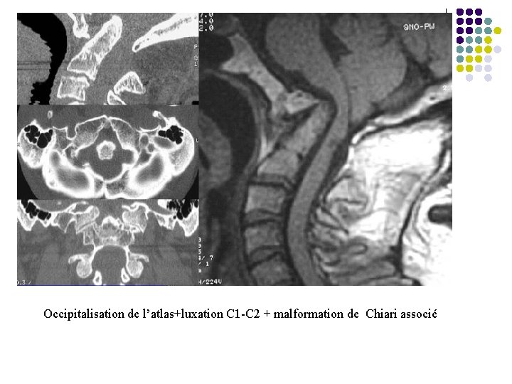 Occipitalisation de l’atlas+luxation C 1 -C 2 + malformation de Chiari associé 