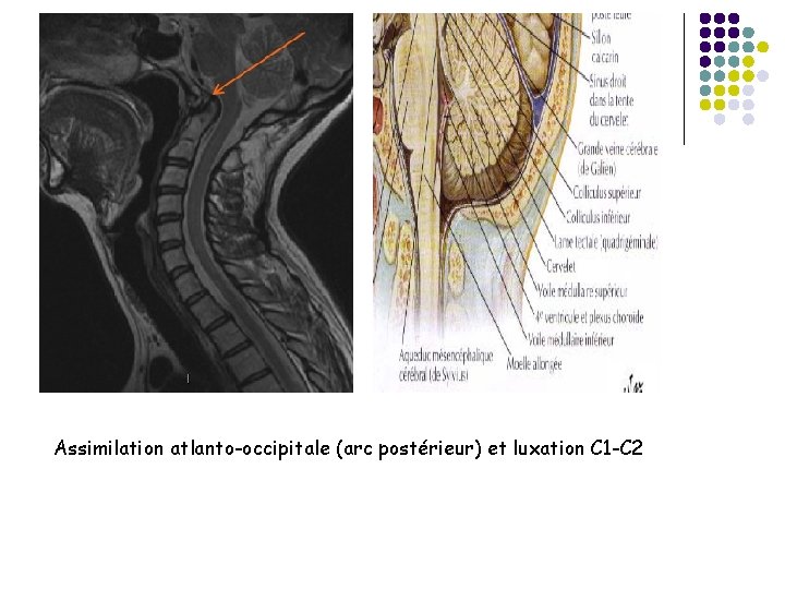 Assimilation atlanto-occipitale (arc postérieur) et luxation C 1 -C 2 