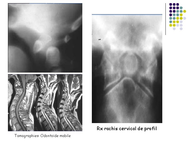 Rx rachis cervical de profil Tomographies: Odontoïde mobile 