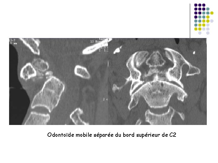 Odontoïde mobile séparée du bord supérieur de C 2 