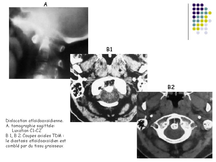 A B 1 B 2 Dislocation atloïdoaxoïdienne. A. tomographie sagittale: Luxation C 1 -C