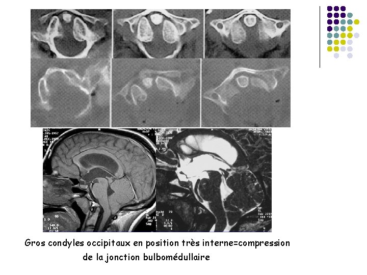Gros condyles occipitaux en position très interne=compression de la jonction bulbomédullaire 