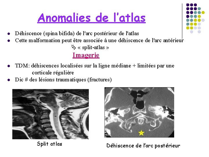 Anomalies de l’atlas l l Déhiscence (spina bifida) de l'arc postérieur de l'atlas Cette