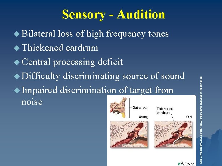 Sensory - Audition u Bilateral loss of high frequency tones u Thickened eardrum u
