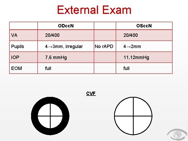 External Exam ODcc. N OScc. N VA 20/400 Pupils 4→ 3 mm, irregular IOP