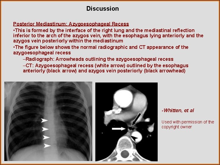 Discussion Posterior Mediastinum: Azygoesophageal Recess • This is formed by the interface of the