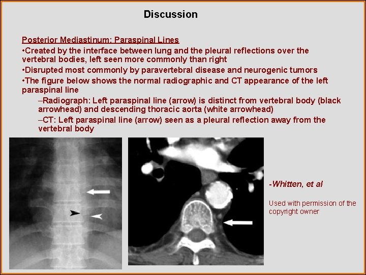 Discussion Posterior Mediastinum: Paraspinal Lines • Created by the interface between lung and the