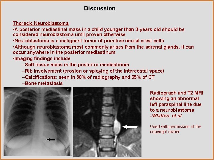 Discussion Thoracic Neuroblastoma • A posterior mediastinal mass in a child younger than 3