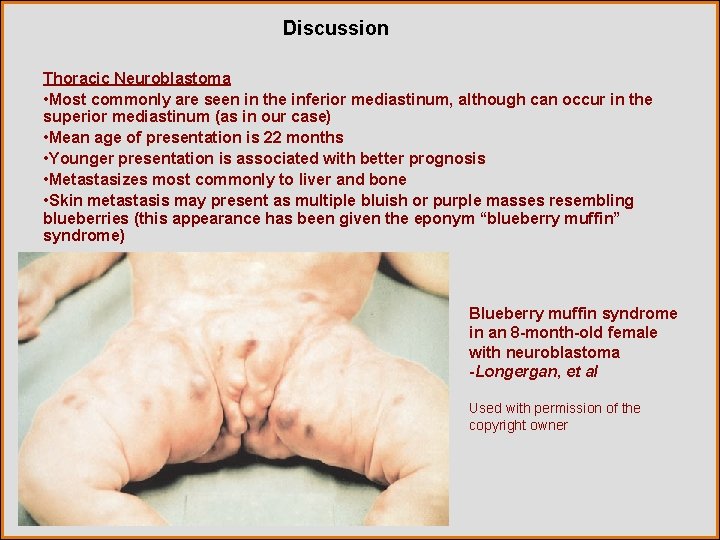 Discussion Thoracic Neuroblastoma • Most commonly are seen in the inferior mediastinum, although can