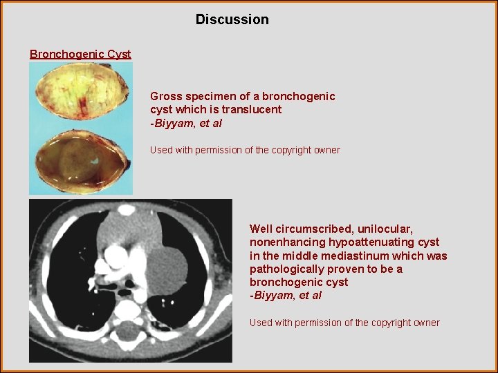 Discussion Bronchogenic Cyst Gross specimen of a bronchogenic cyst which is translucent -Biyyam, et