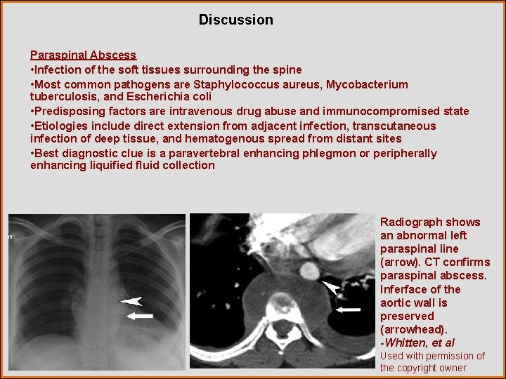 Discussion Paraspinal Abscess • Infection of the soft tissues surrounding the spine • Most