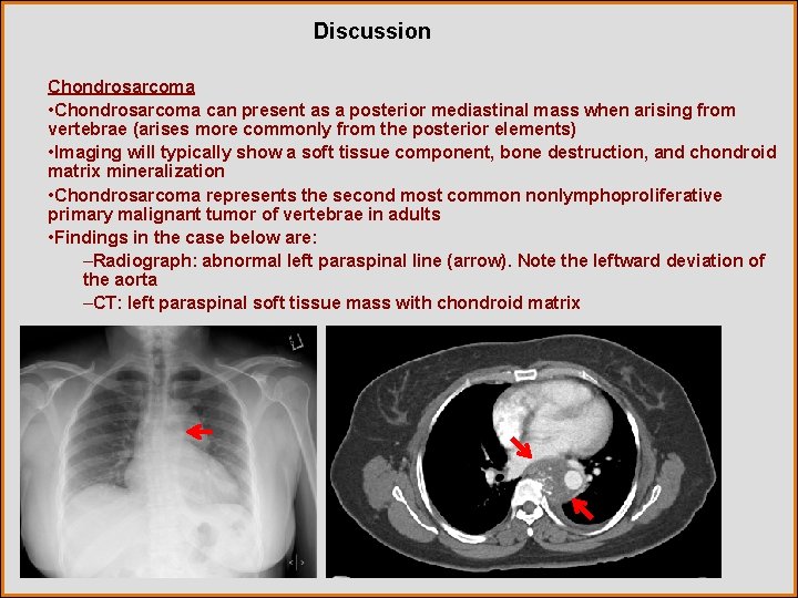 Discussion Chondrosarcoma • Chondrosarcoma can present as a posterior mediastinal mass when arising from