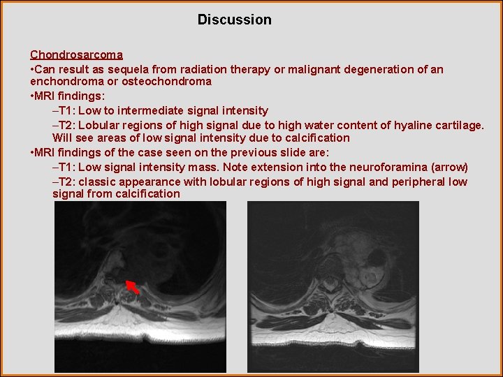 Discussion Chondrosarcoma • Can result as sequela from radiation therapy or malignant degeneration of