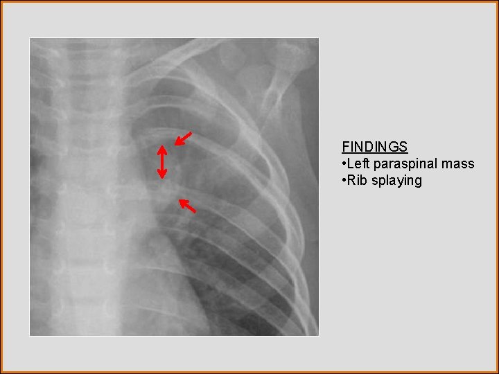 FINDINGS • Left paraspinal mass • Rib splaying 