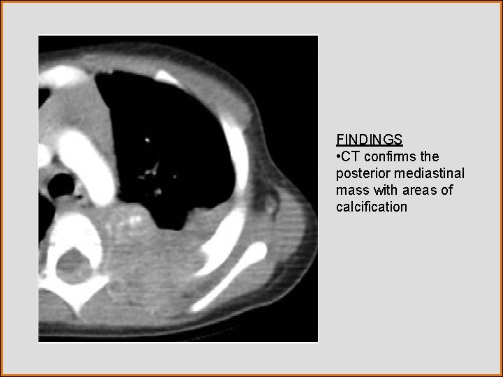 FINDINGS • CT confirms the posterior mediastinal mass with areas of calcification 
