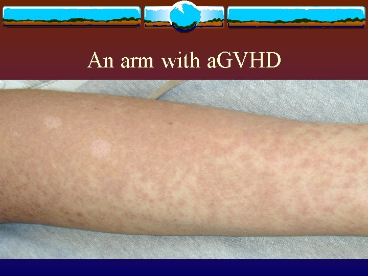 An arm with a. GVHD 