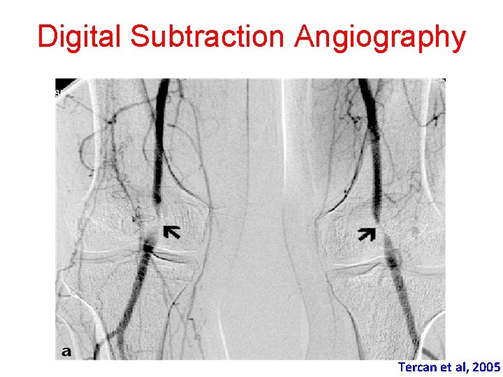 Digital Subtraction Angiography Tercan et al, 2005 