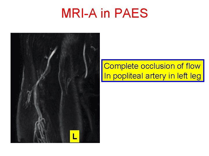 MRI-A in PAES Complete occlusion of flow In popliteal artery in left leg L