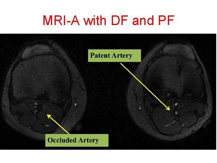 MRI-A with DF and PF 