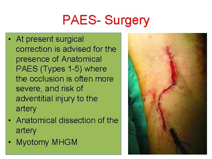 PAES- Surgery • At present surgical correction is advised for the presence of Anatomical