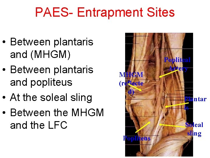 PAES- Entrapment Sites • Between plantaris and (MHGM) • Between plantaris and popliteus •