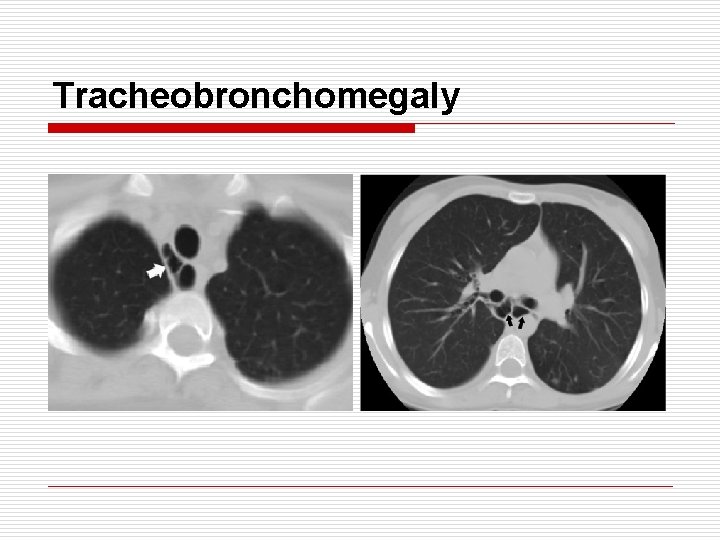 Tracheobronchomegaly 