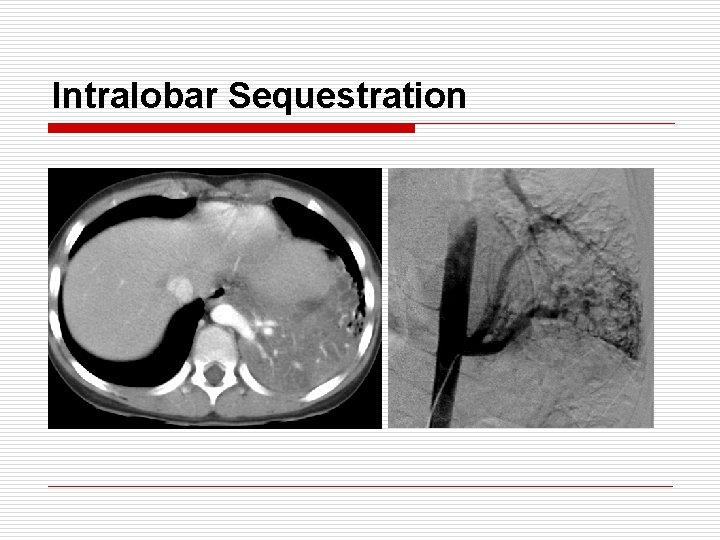 Intralobar Sequestration 