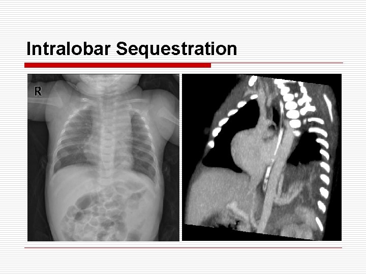 Intralobar Sequestration 