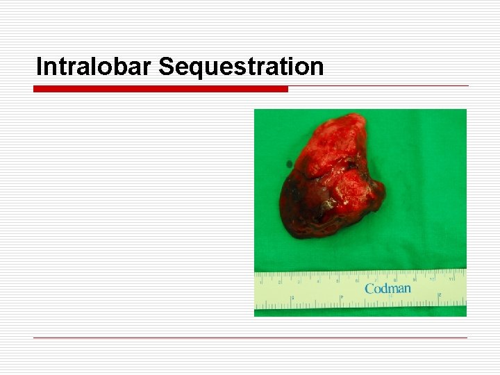 Intralobar Sequestration 