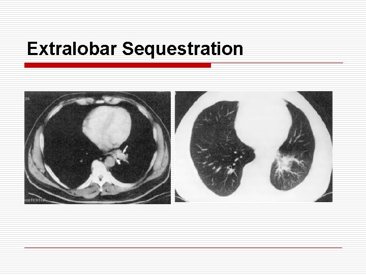 Extralobar Sequestration 