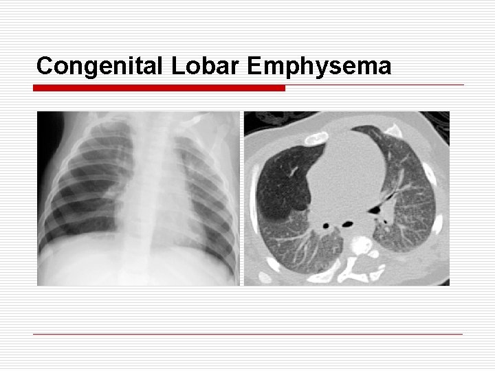 Congenital Lobar Emphysema 