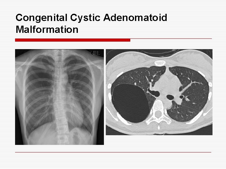 Congenital Cystic Adenomatoid Malformation 