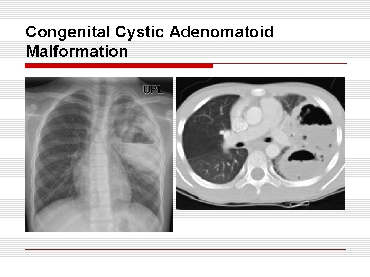 Congenital Cystic Adenomatoid Malformation 