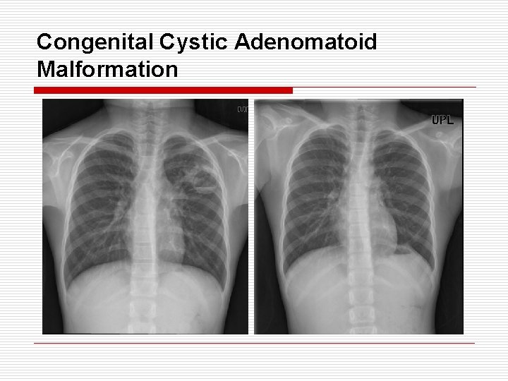 Congenital Cystic Adenomatoid Malformation 
