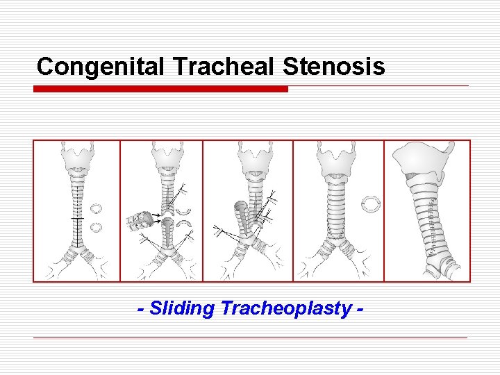 Congenital Tracheal Stenosis - Sliding Tracheoplasty - 