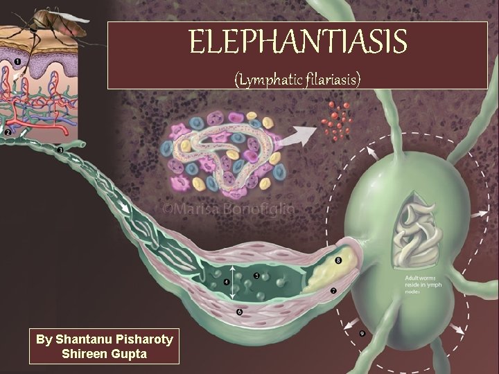 ELEPHANTIASIS (Lymphatic filariasis) By Shantanu Pisharoty Shireen Gupta 