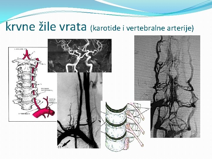 krvne žile vrata (karotide i vertebralne arterije) 