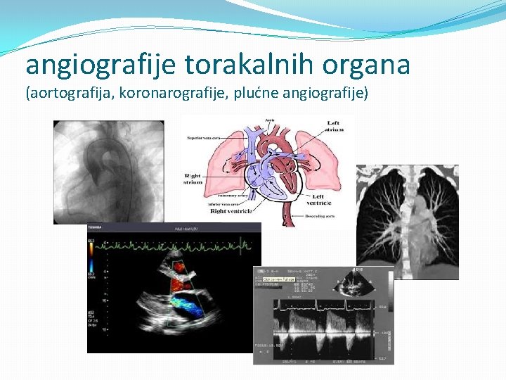 angiografije torakalnih organa (aortografija, koronarografije, plućne angiografije) 