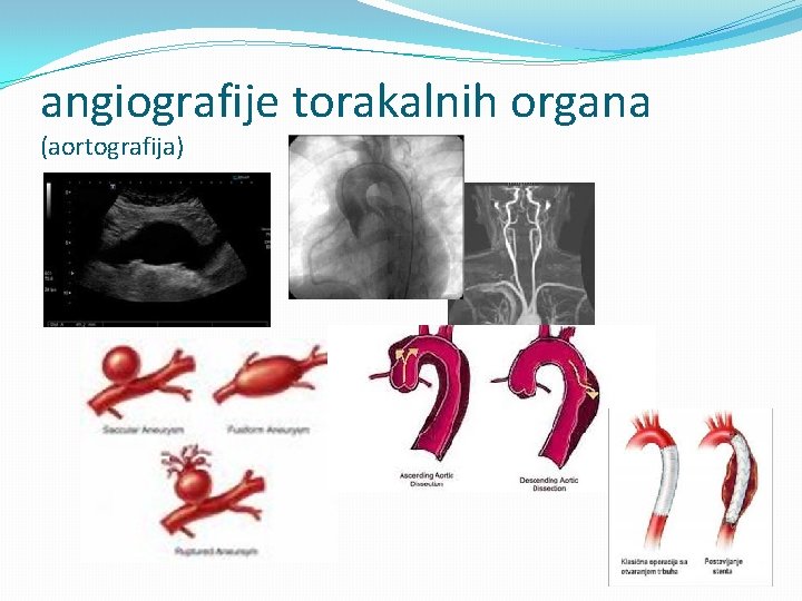 angiografije torakalnih organa (aortografija) 
