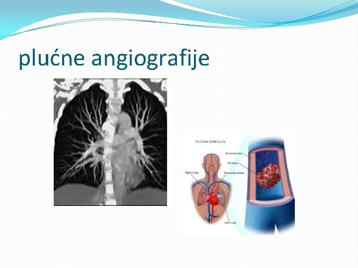 plućne angiografije 