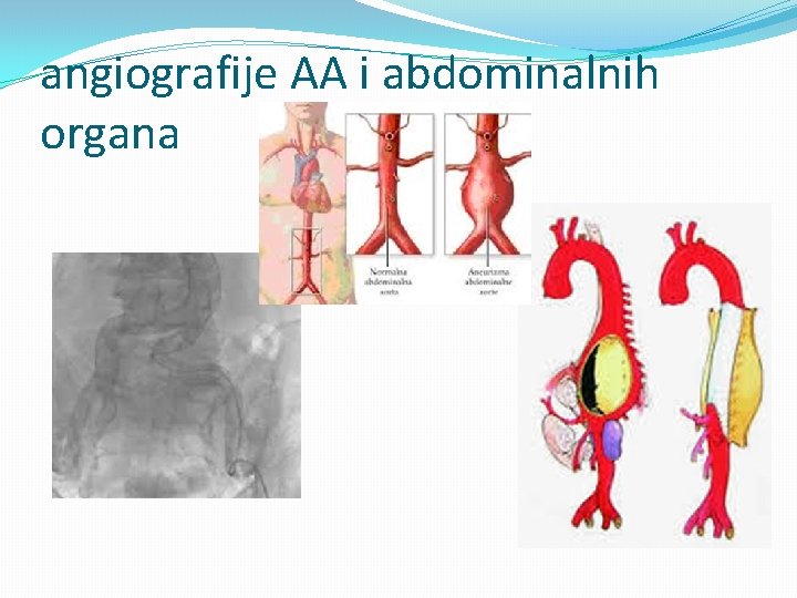 angiografije AA i abdominalnih organa 